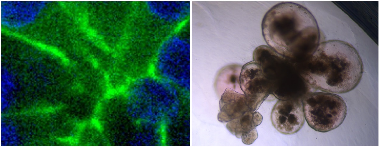 A la izquierda, crecimiento de células tumorales en modelo 3D; a la derecha, organoide que imita la actividad de pulmones reales.